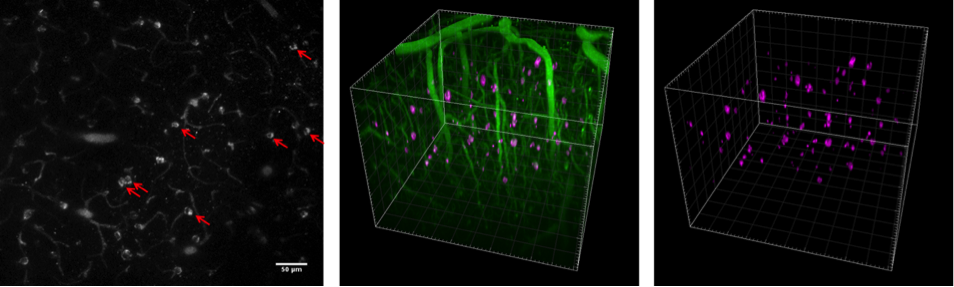 : in vivo two-photon images of superficial cortex layers in a 5.5 month old Tau.P301S animal 24h following Methoxy-X04 injection (ip) are shown as an optical section (left) and as a 3D projection (middle and right). Labelled Tau aggregates are indicated with red arrows (left) or highlighted using purple pseudo-color (middle and right). Scalebar and grid: 50 μm.